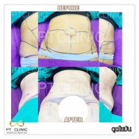 S__131678567.jpg - ดูดไขมัน แผลเล็กมาก เจ็บน้อย ชิวชิว ไม่ต้องวางยา | https://ptinfinity.com