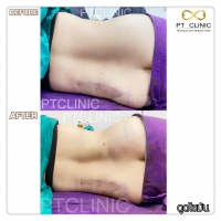 S__131678568.jpg - ดูดไขมัน แผลเล็กมาก เจ็บน้อย ชิวชิว ไม่ต้องวางยา | https://ptinfinity.com