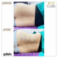 S__131678569.jpg - ดูดไขมัน แผลเล็กมาก เจ็บน้อย ชิวชิว ไม่ต้องวางยา | https://ptinfinity.com