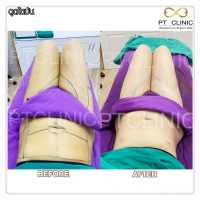 S__131678570.jpg - ดูดไขมัน แผลเล็กมาก เจ็บน้อย ชิวชิว ไม่ต้องวางยา | https://ptinfinity.com