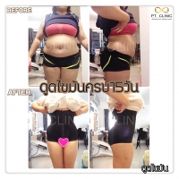 S__131678572.jpg - ดูดไขมัน แผลเล็กมาก เจ็บน้อย ชิวชิว ไม่ต้องวางยา | https://ptinfinity.com