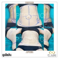 S__131678573.jpg - ดูดไขมัน แผลเล็กมาก เจ็บน้อย ชิวชิว ไม่ต้องวางยา | https://ptinfinity.com