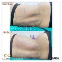 S__131678574.jpg - ดูดไขมัน แผลเล็กมาก เจ็บน้อย ชิวชิว ไม่ต้องวางยา | https://ptinfinity.com