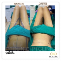 S__131678575.jpg - ดูดไขมัน แผลเล็กมาก เจ็บน้อย ชิวชิว ไม่ต้องวางยา | https://ptinfinity.com