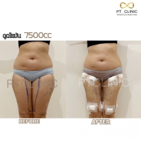 S__131678576.jpg - ดูดไขมัน แผลเล็กมาก เจ็บน้อย ชิวชิว ไม่ต้องวางยา | https://ptinfinity.com