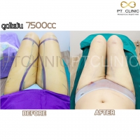 S__131678577.jpg - ดูดไขมัน แผลเล็กมาก เจ็บน้อย ชิวชิว ไม่ต้องวางยา | https://ptinfinity.com