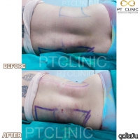 S__131678578.jpg - ดูดไขมัน แผลเล็กมาก เจ็บน้อย ชิวชิว ไม่ต้องวางยา | https://ptinfinity.com