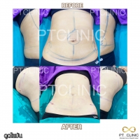 S__131678580.jpg - ดูดไขมัน แผลเล็กมาก เจ็บน้อย ชิวชิว ไม่ต้องวางยา | https://ptinfinity.com