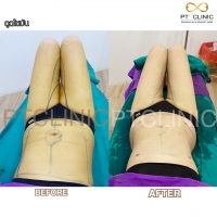 S__131678581.jpg - ดูดไขมัน แผลเล็กมาก เจ็บน้อย ชิวชิว ไม่ต้องวางยา | https://ptinfinity.com