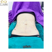 S__131678583.jpg - ดูดไขมัน แผลเล็กมาก เจ็บน้อย ชิวชิว ไม่ต้องวางยา | https://ptinfinity.com