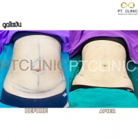 S__131678584.jpg - ดูดไขมัน แผลเล็กมาก เจ็บน้อย ชิวชิว ไม่ต้องวางยา | https://ptinfinity.com