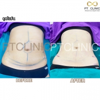 S__131678585.jpg - ดูดไขมัน แผลเล็กมาก เจ็บน้อย ชิวชิว ไม่ต้องวางยา | https://ptinfinity.com