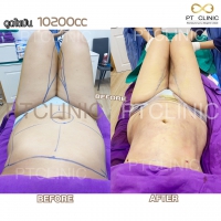 S__131678586.jpg - ดูดไขมัน แผลเล็กมาก เจ็บน้อย ชิวชิว ไม่ต้องวางยา | https://ptinfinity.com