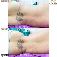 S__131678587.jpg - ดูดไขมัน แผลเล็กมาก เจ็บน้อย ชิวชิว ไม่ต้องวางยา | https://ptinfinity.com