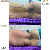 S__131678588.jpg - ดูดไขมัน แผลเล็กมาก เจ็บน้อย ชิวชิว ไม่ต้องวางยา | https://ptinfinity.com