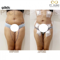 S__131678590.jpg - ดูดไขมัน แผลเล็กมาก เจ็บน้อย ชิวชิว ไม่ต้องวางยา | https://ptinfinity.com