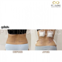 S__131678591.jpg - ดูดไขมัน แผลเล็กมาก เจ็บน้อย ชิวชิว ไม่ต้องวางยา | https://ptinfinity.com