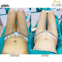 S__131678592.jpg - ดูดไขมัน แผลเล็กมาก เจ็บน้อย ชิวชิว ไม่ต้องวางยา | https://ptinfinity.com