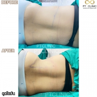 S__131678595.jpg - ดูดไขมัน แผลเล็กมาก เจ็บน้อย ชิวชิว ไม่ต้องวางยา | https://ptinfinity.com