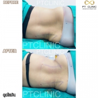 S__131678596.jpg - ดูดไขมัน แผลเล็กมาก เจ็บน้อย ชิวชิว ไม่ต้องวางยา | https://ptinfinity.com