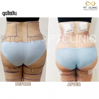 S__131678598.jpg - ดูดไขมัน แผลเล็กมาก เจ็บน้อย ชิวชิว ไม่ต้องวางยา | https://ptinfinity.com