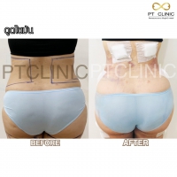 S__131678599.jpg - ดูดไขมัน แผลเล็กมาก เจ็บน้อย ชิวชิว ไม่ต้องวางยา | https://ptinfinity.com