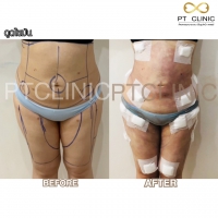 S__131678600.jpg - ดูดไขมัน แผลเล็กมาก เจ็บน้อย ชิวชิว ไม่ต้องวางยา | https://ptinfinity.com