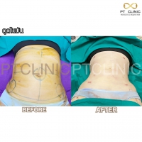 S__131678601.jpg - ดูดไขมัน แผลเล็กมาก เจ็บน้อย ชิวชิว ไม่ต้องวางยา | https://ptinfinity.com