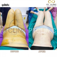 S__131678602.jpg - ดูดไขมัน แผลเล็กมาก เจ็บน้อย ชิวชิว ไม่ต้องวางยา | https://ptinfinity.com