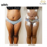 S__131678603.jpg - ดูดไขมัน แผลเล็กมาก เจ็บน้อย ชิวชิว ไม่ต้องวางยา | https://ptinfinity.com