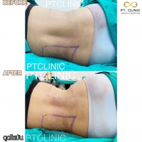 S__131678606.jpg - ดูดไขมัน แผลเล็กมาก เจ็บน้อย ชิวชิว ไม่ต้องวางยา | https://ptinfinity.com