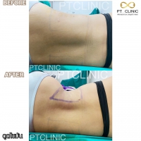 S__131678607.jpg - ดูดไขมัน แผลเล็กมาก เจ็บน้อย ชิวชิว ไม่ต้องวางยา | https://ptinfinity.com