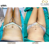 S__131678608.jpg - ดูดไขมัน แผลเล็กมาก เจ็บน้อย ชิวชิว ไม่ต้องวางยา | https://ptinfinity.com