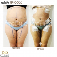 S__131678609.jpg - ดูดไขมัน แผลเล็กมาก เจ็บน้อย ชิวชิว ไม่ต้องวางยา | https://ptinfinity.com