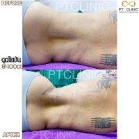 S__131678610.jpg - ดูดไขมัน แผลเล็กมาก เจ็บน้อย ชิวชิว ไม่ต้องวางยา | https://ptinfinity.com