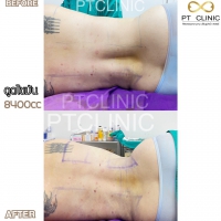 S__131678611.jpg - ดูดไขมัน แผลเล็กมาก เจ็บน้อย ชิวชิว ไม่ต้องวางยา | https://ptinfinity.com