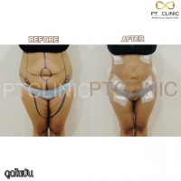 S__131678613.jpg - ดูดไขมัน แผลเล็กมาก เจ็บน้อย ชิวชิว ไม่ต้องวางยา | https://ptinfinity.com