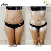 S__131678616.jpg - ดูดไขมัน แผลเล็กมาก เจ็บน้อย ชิวชิว ไม่ต้องวางยา | https://ptinfinity.com