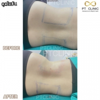 S__131678618.jpg - ดูดไขมัน แผลเล็กมาก เจ็บน้อย ชิวชิว ไม่ต้องวางยา | https://ptinfinity.com