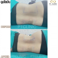 S__131678619.jpg - ดูดไขมัน แผลเล็กมาก เจ็บน้อย ชิวชิว ไม่ต้องวางยา | https://ptinfinity.com