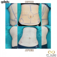 S__131678620.jpg - ดูดไขมัน แผลเล็กมาก เจ็บน้อย ชิวชิว ไม่ต้องวางยา | https://ptinfinity.com