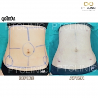 S__131678621.jpg - ดูดไขมัน แผลเล็กมาก เจ็บน้อย ชิวชิว ไม่ต้องวางยา | https://ptinfinity.com