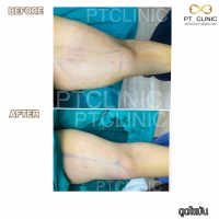 S__131678623.jpg - ดูดไขมัน แผลเล็กมาก เจ็บน้อย ชิวชิว ไม่ต้องวางยา | https://ptinfinity.com