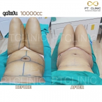 S__131678624.jpg - ดูดไขมัน แผลเล็กมาก เจ็บน้อย ชิวชิว ไม่ต้องวางยา | https://ptinfinity.com