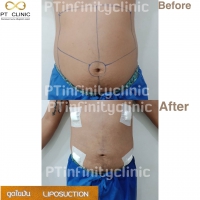 S__131891217.jpg - ดูดไขมัน แผลเล็กมาก เจ็บน้อย ชิวชิว ไม่ต้องวางยา | https://ptinfinity.com