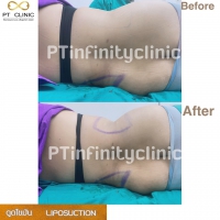 S__131891220.jpg - ดูดไขมัน แผลเล็กมาก เจ็บน้อย ชิวชิว ไม่ต้องวางยา | https://ptinfinity.com