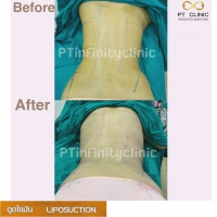 S__131891222.jpg - ดูดไขมัน แผลเล็กมาก เจ็บน้อย ชิวชิว ไม่ต้องวางยา | https://ptinfinity.com