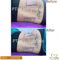 S__131891223.jpg - ดูดไขมัน แผลเล็กมาก เจ็บน้อย ชิวชิว ไม่ต้องวางยา | https://ptinfinity.com