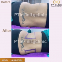 S__131891224.jpg - ดูดไขมัน แผลเล็กมาก เจ็บน้อย ชิวชิว ไม่ต้องวางยา | https://ptinfinity.com