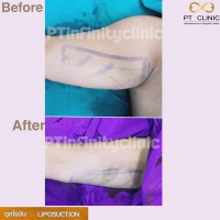 S__131891225.jpg - ดูดไขมัน แผลเล็กมาก เจ็บน้อย ชิวชิว ไม่ต้องวางยา | https://ptinfinity.com